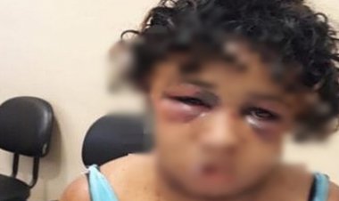 Jovem de 24 anos é agredida e queimada com maçarico no rosto em Salvador; namorado é procurado